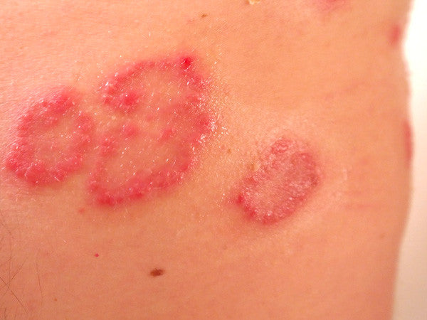 Psoriasis behandling med olje